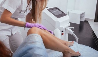 laser removal of unwanted hair