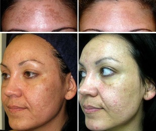 Before and after non-ablative fractional laser rejuvenation