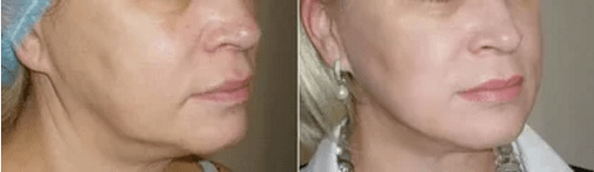 Easy skin rejuvenation