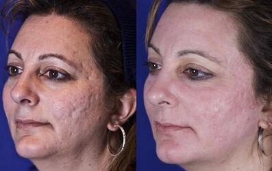 fractional laser rejuvenation before and after photos