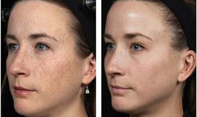 fractional facial rejuvenation before and after photos